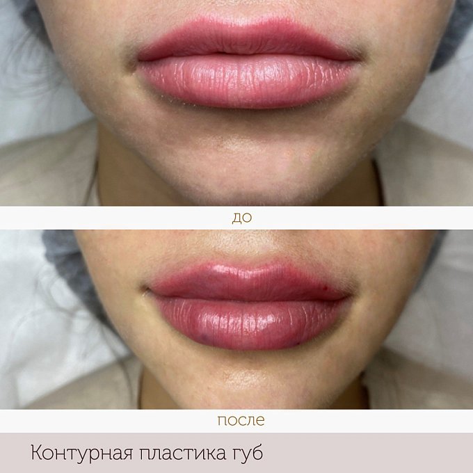 Фото процедуры 2