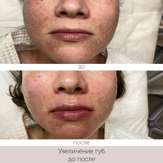 Фото процедуры 14
